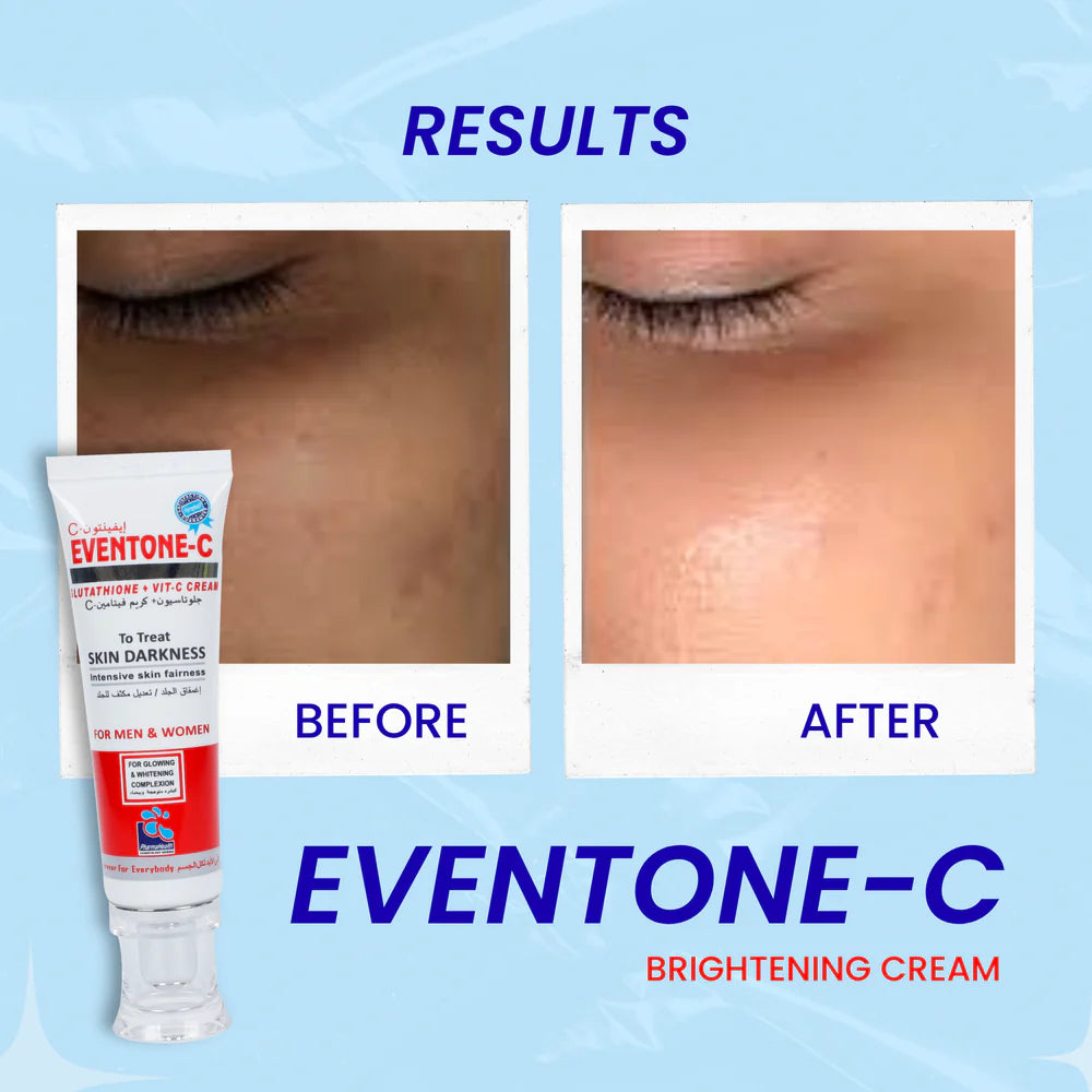 Eventone-C Cream 30G